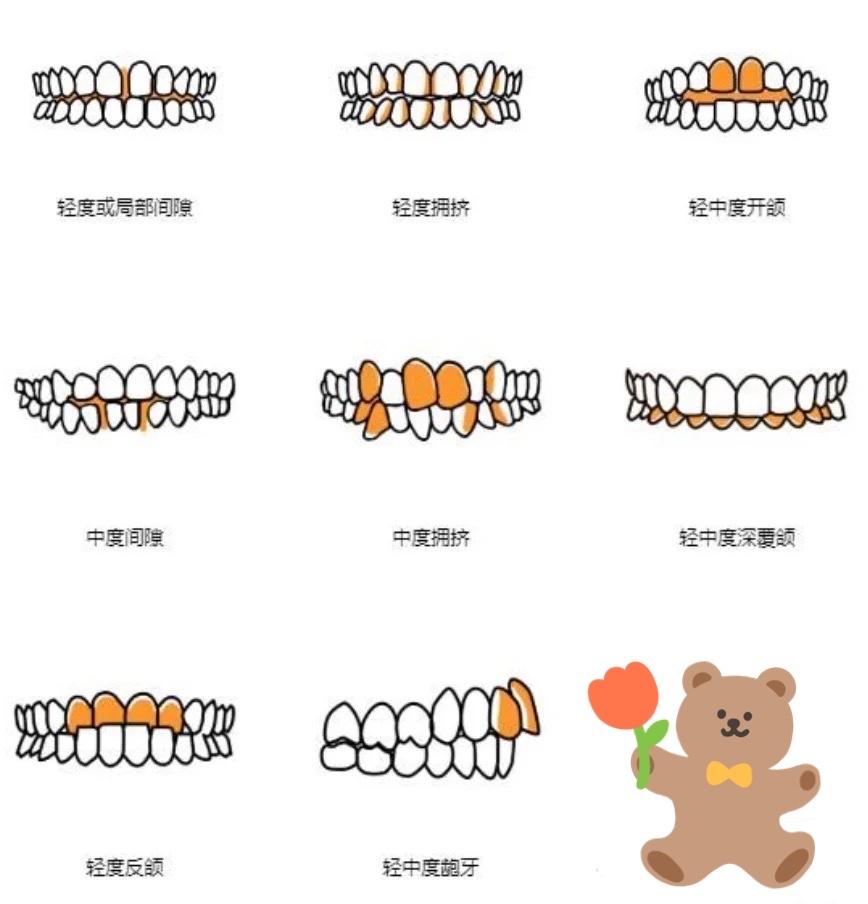 正畸矫正全过程分享,正畸医生的总结