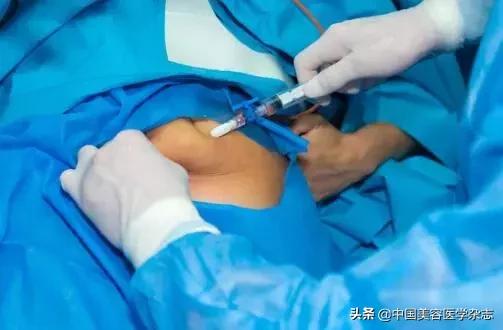 专栏｜《中国美容医学》2019年2期—自体脂肪移植