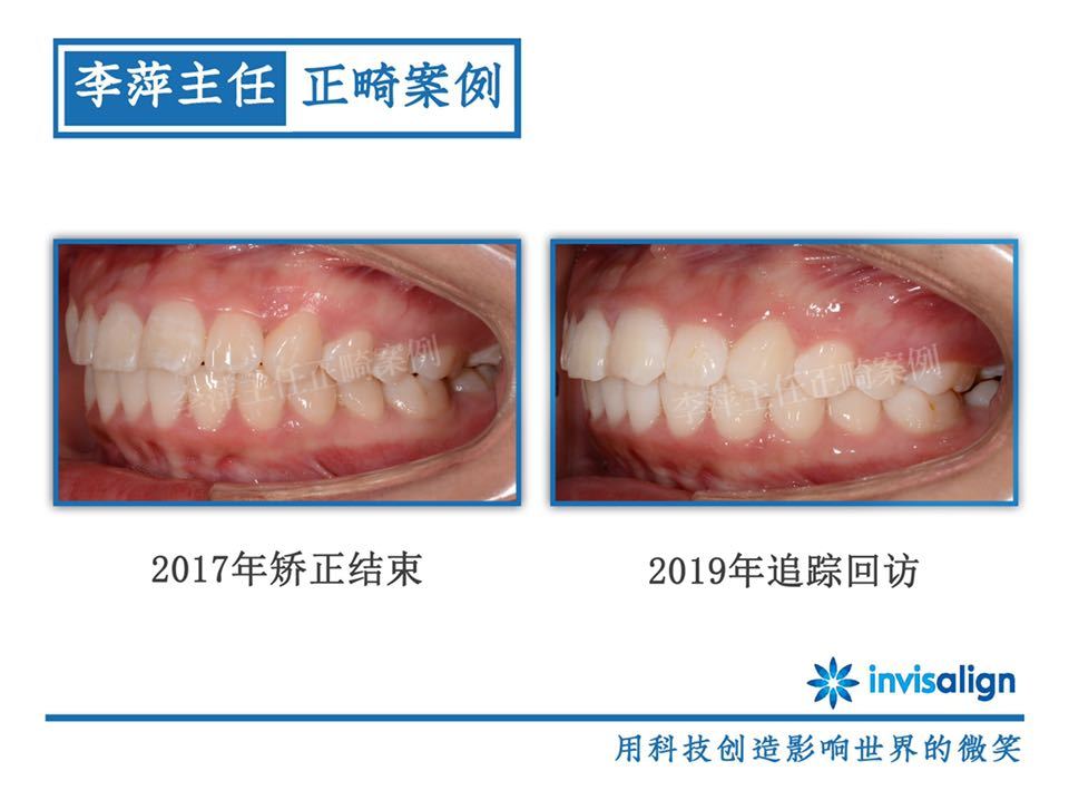 太原隐形牙齿矫正哪家靠谱,太原李萍正畸怎么样