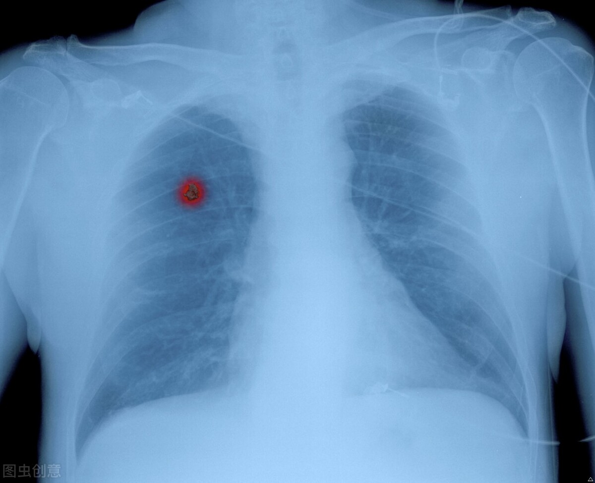 肺癌肉瘤样癌靶向治疗效果,肺癌4期靶向治疗