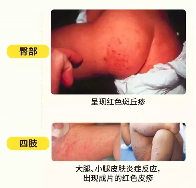 多地流感病人爆发如何预防,如何预防下一场流行病的爆发