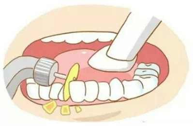 拔牙矫正的真实经历,拔牙矫正后悔的真实案例