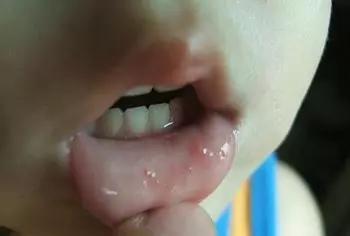 宝宝溃疡是缺什么吗,一岁半宝宝上火嘴里溃疡怎么办