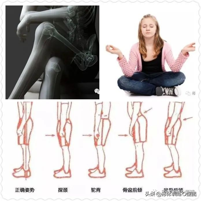 怎样矫正o型腿罗圈腿,罗圈腿和o型腿是怎么形成的