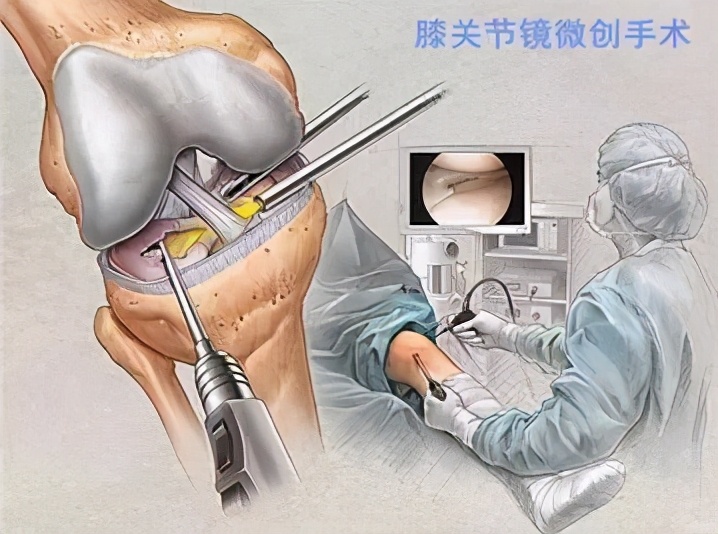 膝盖总是疼半月板损伤怎么治,膝盖一直痛是什么病