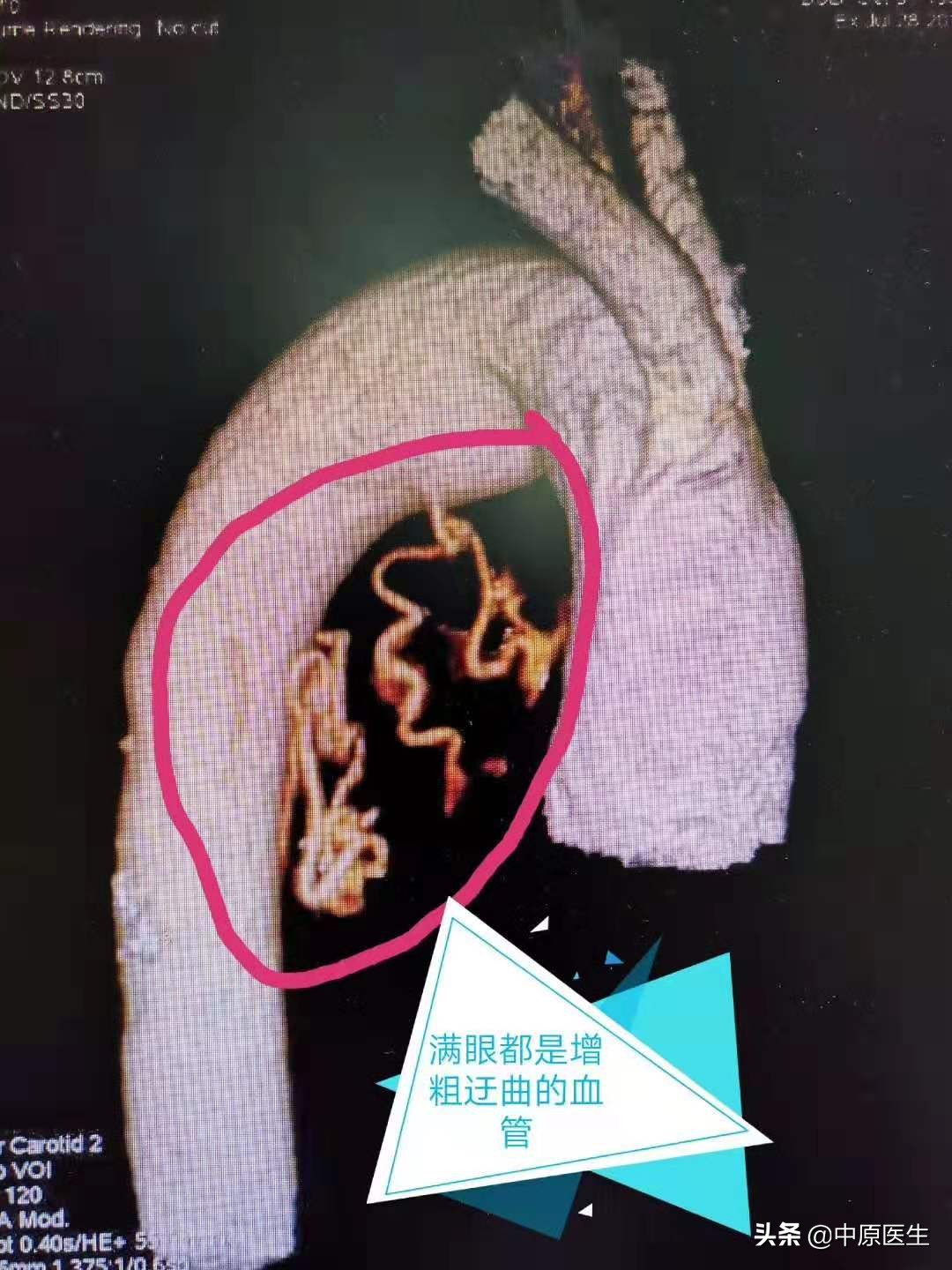 老人得肝癌的保守治疗方法,肝癌晚期75岁治疗成功案例