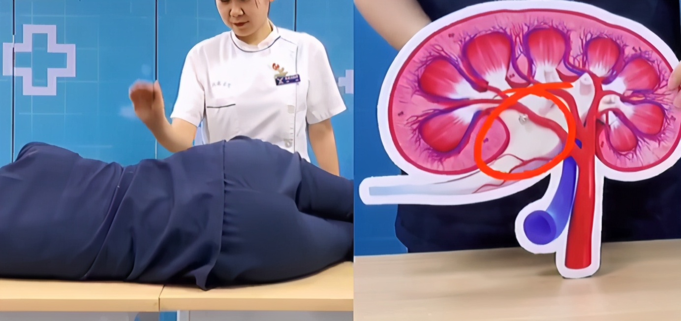 为什么肾结石掉下来肾里还有结石,肾下盏结石排石的正确方法