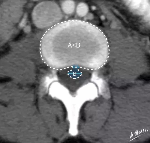 椎间盘脱出和突出片子怎么看,椎间盘膨出的鉴别诊断