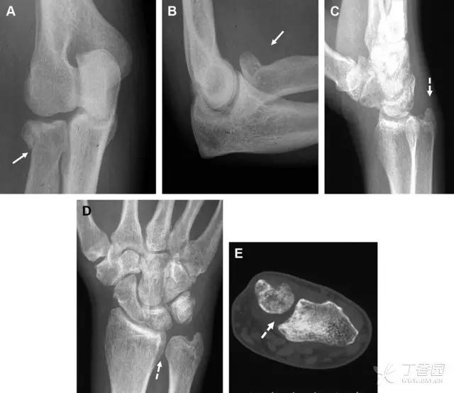 放射科夜班病例大全,放射科容易漏诊的骨折
