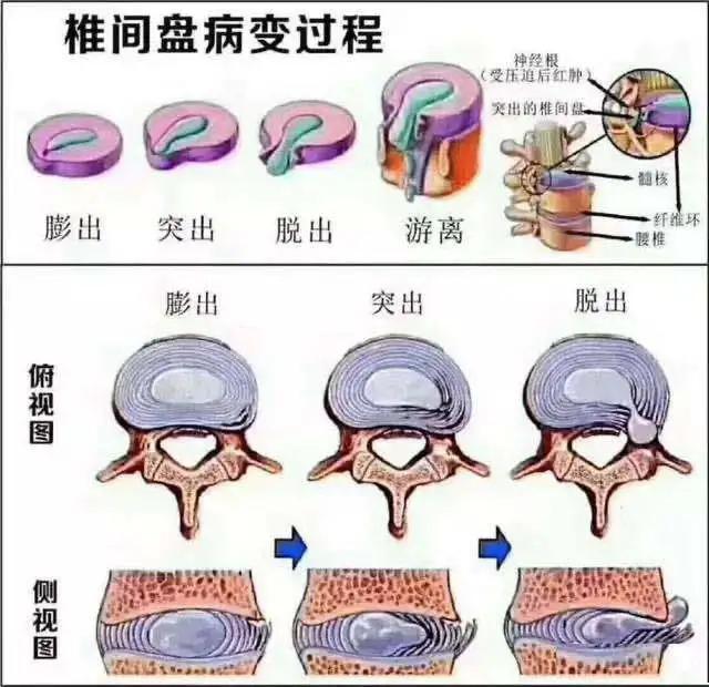 西安治疗腰间盘脱出,腰间盘突出手术患者
