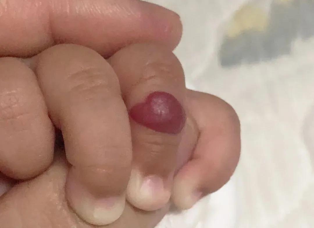 宝宝手指血管瘤治疗方法,手指头上长了个血管瘤怎么治疗