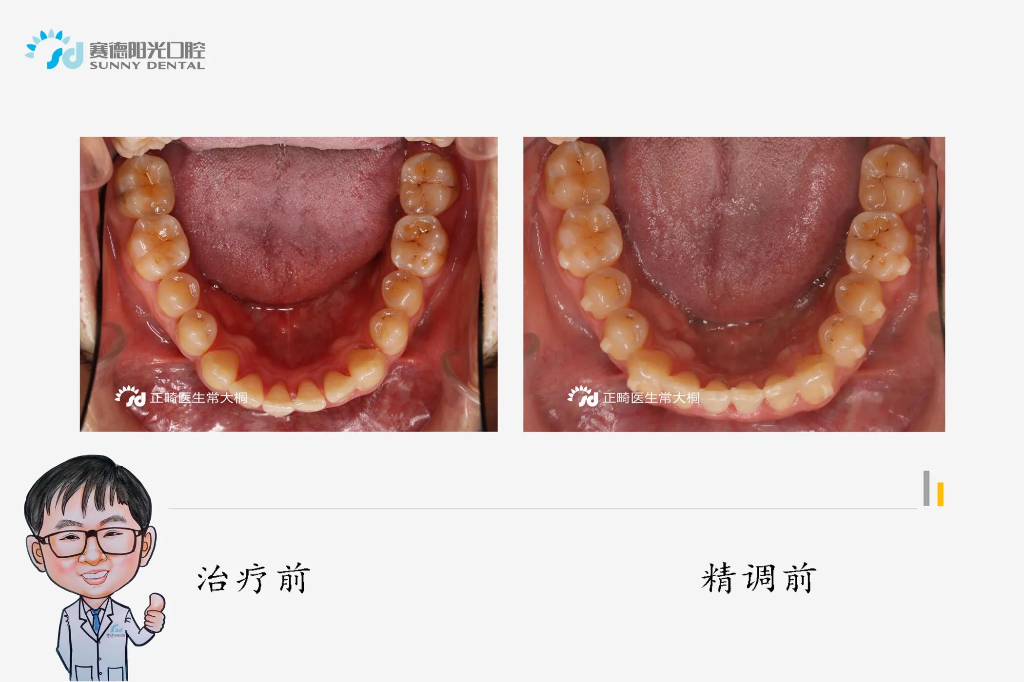 隐适美正畸牙拔掉不美观怎么办,隐适美黑三角什么时候会出现
