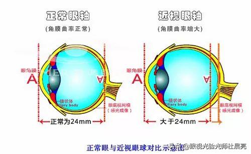作为近视*党**，尤其对于高度近视患者，眼球外突成了一件烦心事
