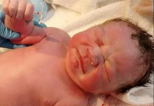 钉在子宫壁上的节育环,遗留在妈妈体内的节育环