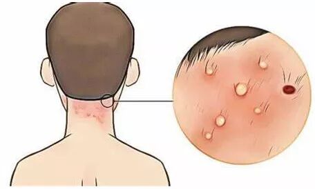 毛囊炎是一个圆形的红疙瘩,毛囊炎起一个很痒的痘