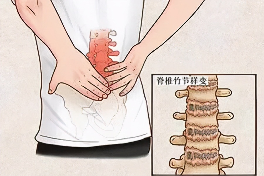 强直病友应该如何进行康复训练,强直后期怎么治疗