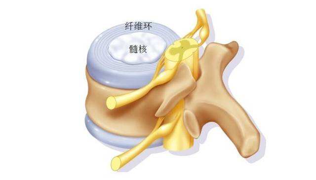 腰椎间盘突出鉴别诊断病例完整,腰椎间盘突出的典型病例分析