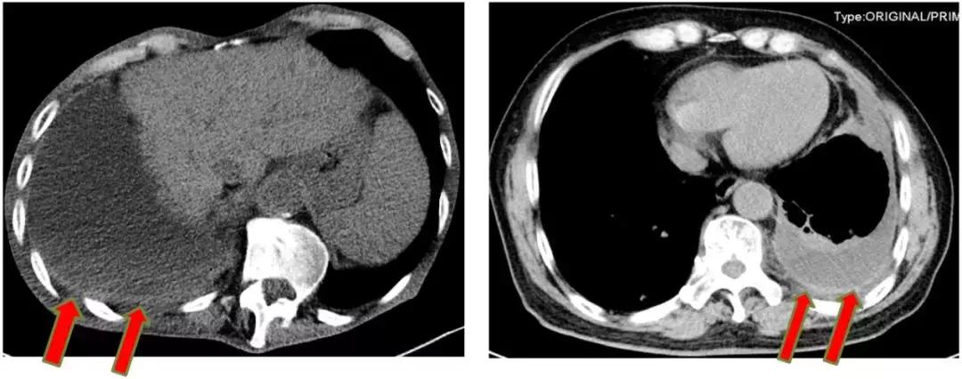 ct引导下穿刺活检诊断的分析,超声引导下穿刺活检什么样子的呢