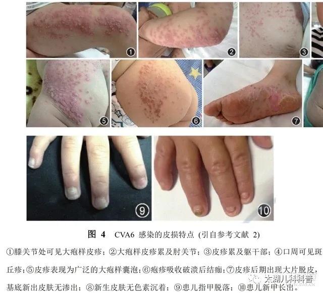 小孩子指甲从根部脱落是怎么回事,孩子手足口病后指甲脱落怎么回事