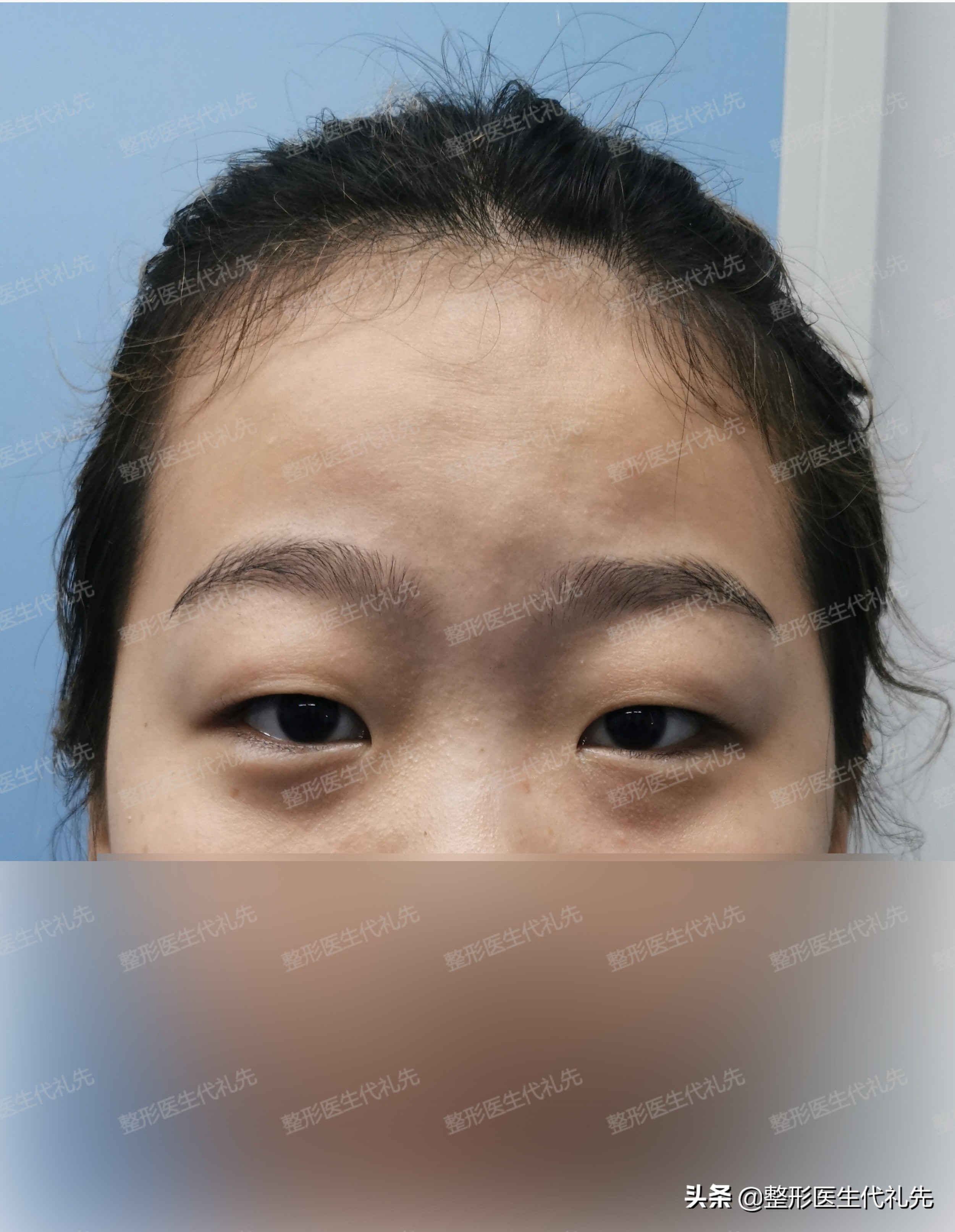 拯救肿泡眼做双眼皮的经历分享,肿眼泡做双眼皮恢复过程经历真实