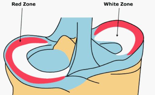 半月板损伤怎么治疗能恢复得快点,半月板损伤腿要多久才能打球