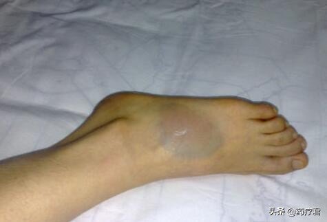 打篮球崴脚肿了冰敷和热敷的时间,崴脚消肿还是疼