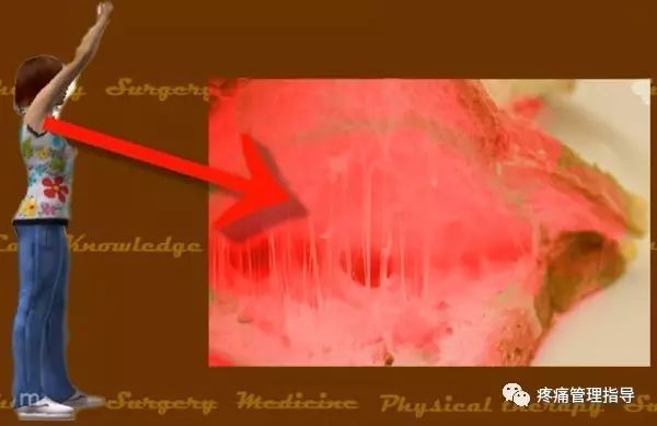 肩周炎的原因与锻炼方法