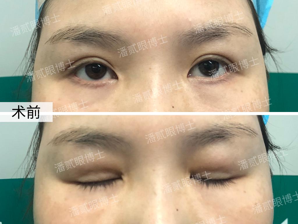 10年前做过韩式双眼皮,做过韩式三点双眼皮还能开眼角吗