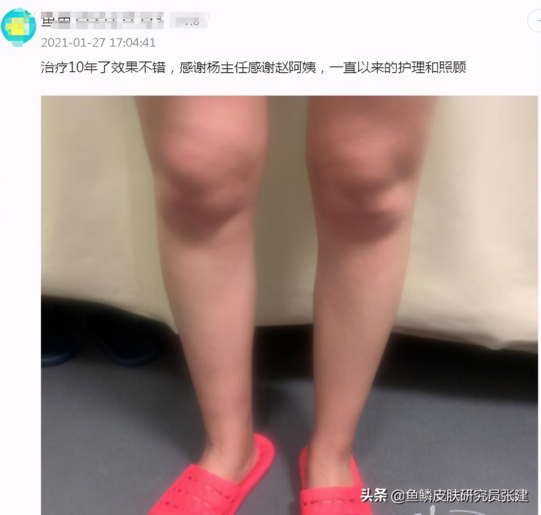 90岁老中医治鱼鳞病,中医实战笔记鱼鳞病