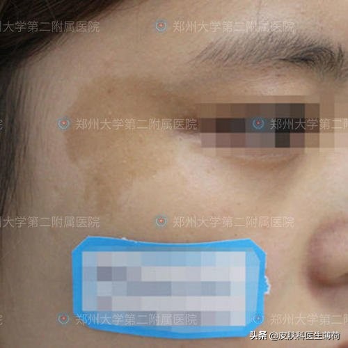 中药点斑好还是激光祛斑好,脸上有斑打激光过后吃有讲究吗