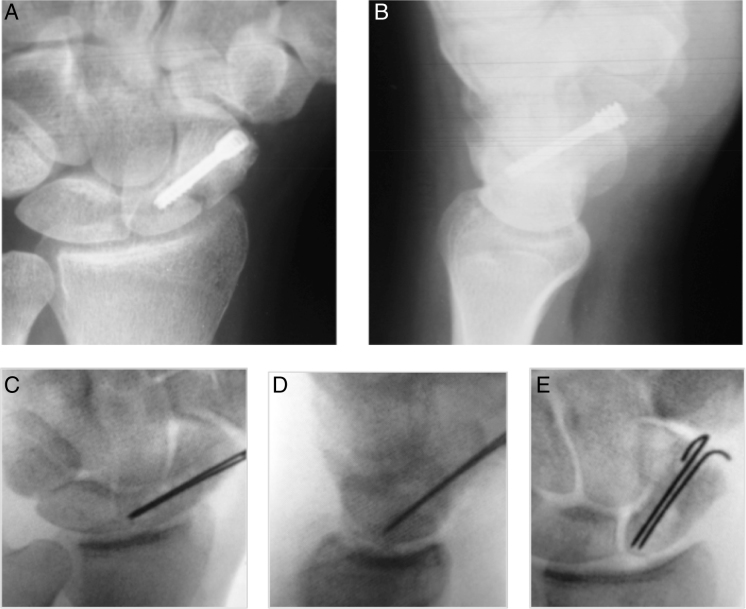 中医治疗腕舟骨骨折,经皮钢板治疗胫骨骨折