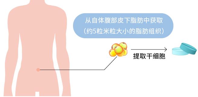 干细胞治疗关节炎个人感受,关节的干细胞治疗过程和原理