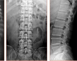 腰椎间盘的膨出和突出有什么区别,腰椎间盘膨出和突出有什么区别