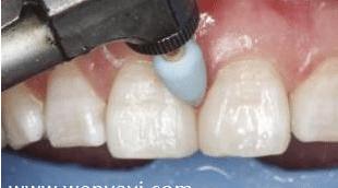 门牙缝可以补吗,门牙有缝怎么办如何补救