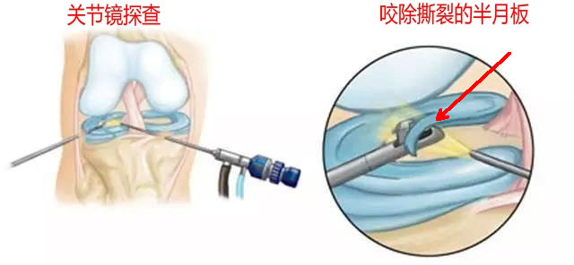 磁共振怎么看半月板损伤程度,磁共振半月板损伤1级是什么