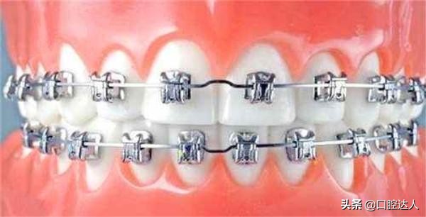 戴上牙套了第二天就后悔了怎么办,戴了牙套之后改变不止一点点