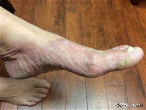 肩肌炎严重吗,从肩到后背疼痛是什么原因