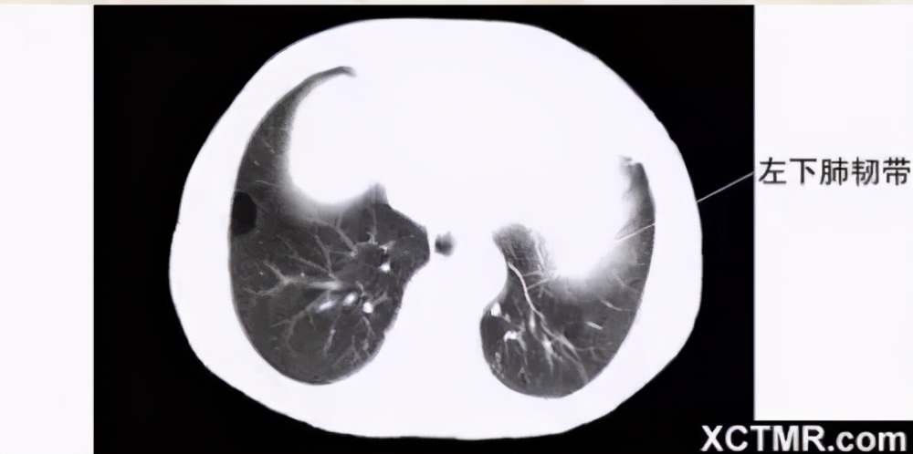 女性盆腔ct断层解剖结构图,女性盆腔脏器ct解剖