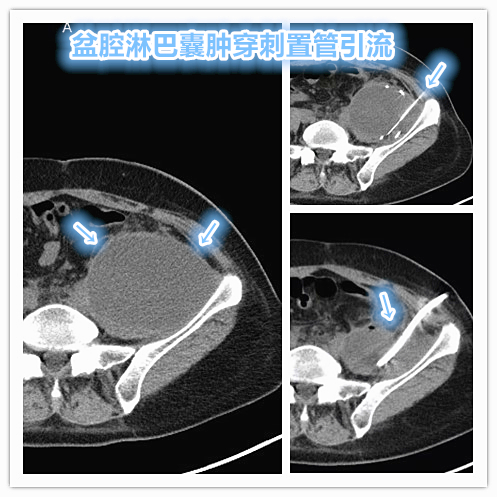 颈部淋巴囊肿反复发作,盆腔淋巴囊肿最快消除方法