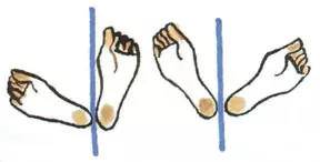 改善跷二郎腿的骨盆倾斜,骨盆倾斜可以反向跷二郎腿吗