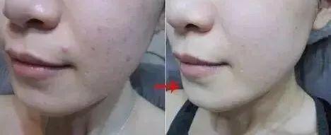 超好用的祛痘膏便宜,有没有好用的祛痘膏推荐女孩子