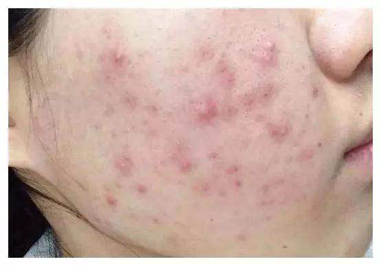 医美祛痘真实经历,微针祛痘坑真实经历