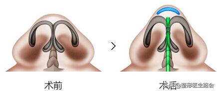 为什么长胖了鼻头也变大,鼻头大瘦下来会不会跟着变小