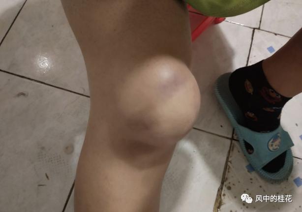 溜冰摔倒了膝盖不能弯曲,溜冰摔倒膝盖肿了怎么办