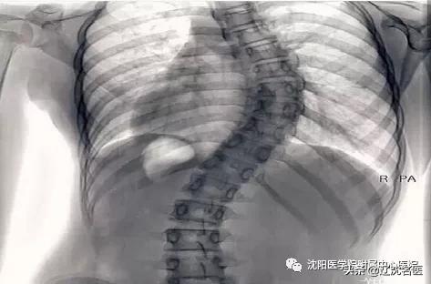 最好的儿童脊柱侧弯医院,简单辨别脊柱侧弯避免孩子走弯路