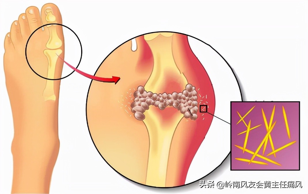 脚趾疼是痛风吗痛风都有什么症状,痛风是怎么引起的痛风有哪些症状
