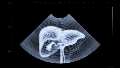 乙肝患者肝硬度值9,乙肝患者肝硬度多少是正常的