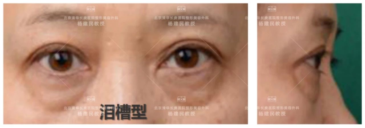 如何分清自己是哪种类型的眼袋,怎么看是哪种类型的眼袋