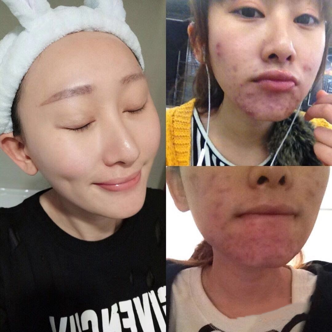 超强祛痘攻略养成不长痘肌肤,祛痘全攻略脸上痘痘真的干净了