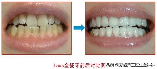 全瓷牙跟烤瓷牙哪种比较难拆掉,老人镶牙用全瓷牙好还是烤瓷牙